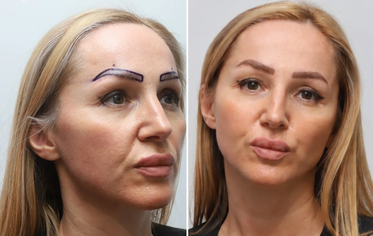 Greffe de sourcils avant et après chez Metropolmed