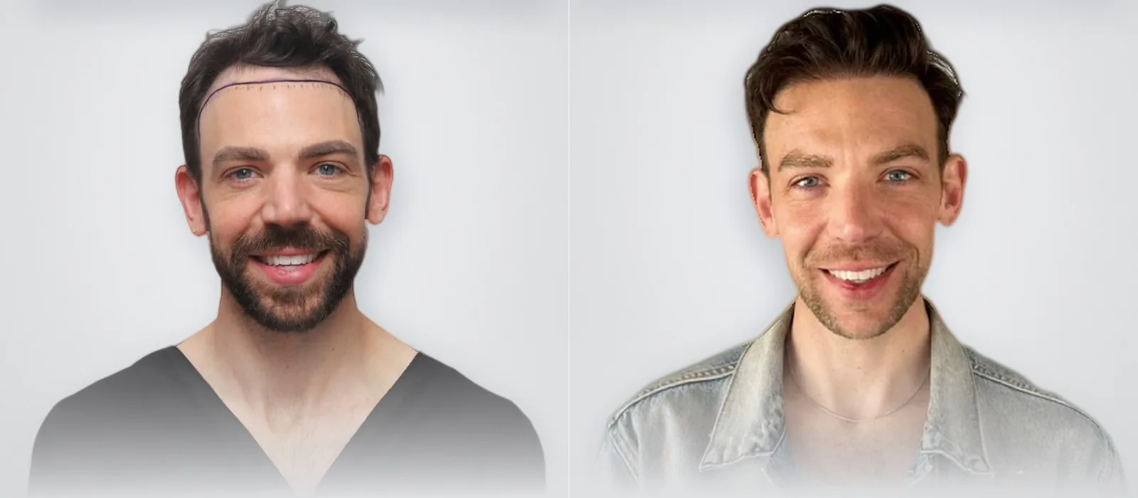 Daniel Coffman قبل زراعة الشعر وبعدها