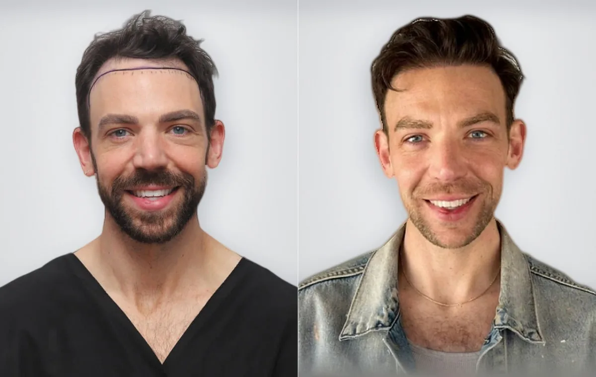 Daniel Coffman قبل زراعة الشعر وبعدها