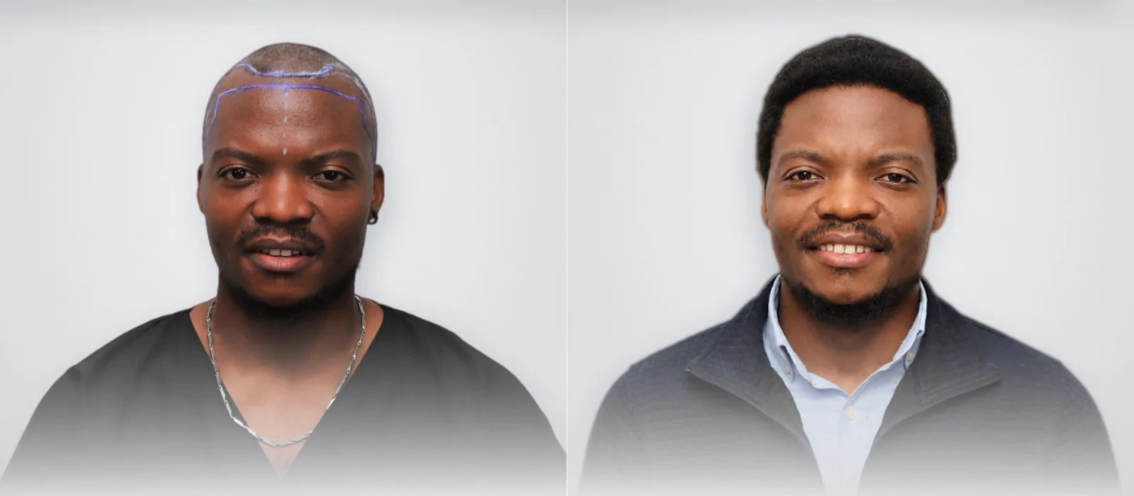 Fabuert Joseph before and after afro hair transplant