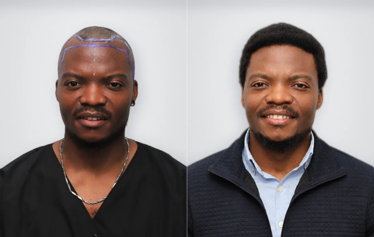 Fabuert Joseph قبل زراعة الشعر الأفريقي (Afro) وبعدها