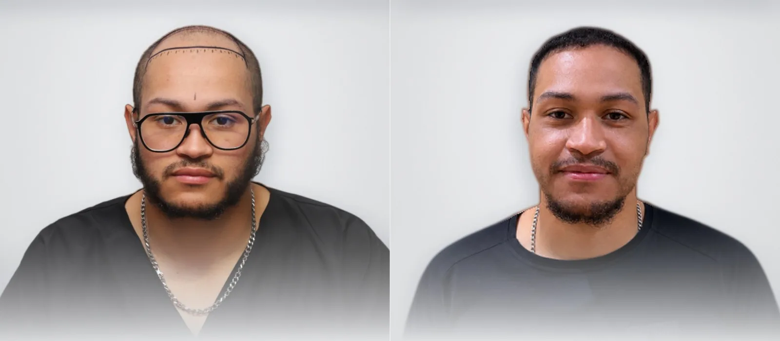 Hoyam Aity قبل زراعة الشعر وبعدها