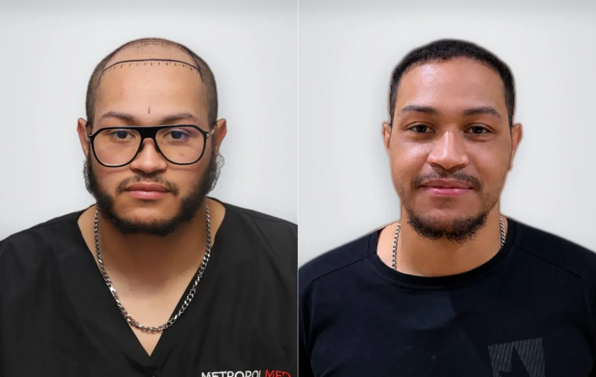 Hoyam Aity قبل زراعة الشعر وبعدها