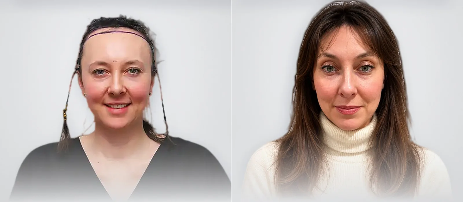 Irina Shirley before and after hair transplant