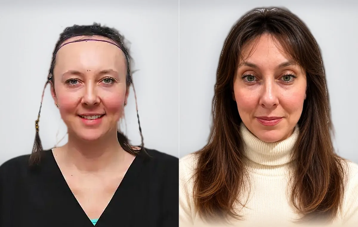 Irina Shirley قبل زراعة الشعر وبعدها