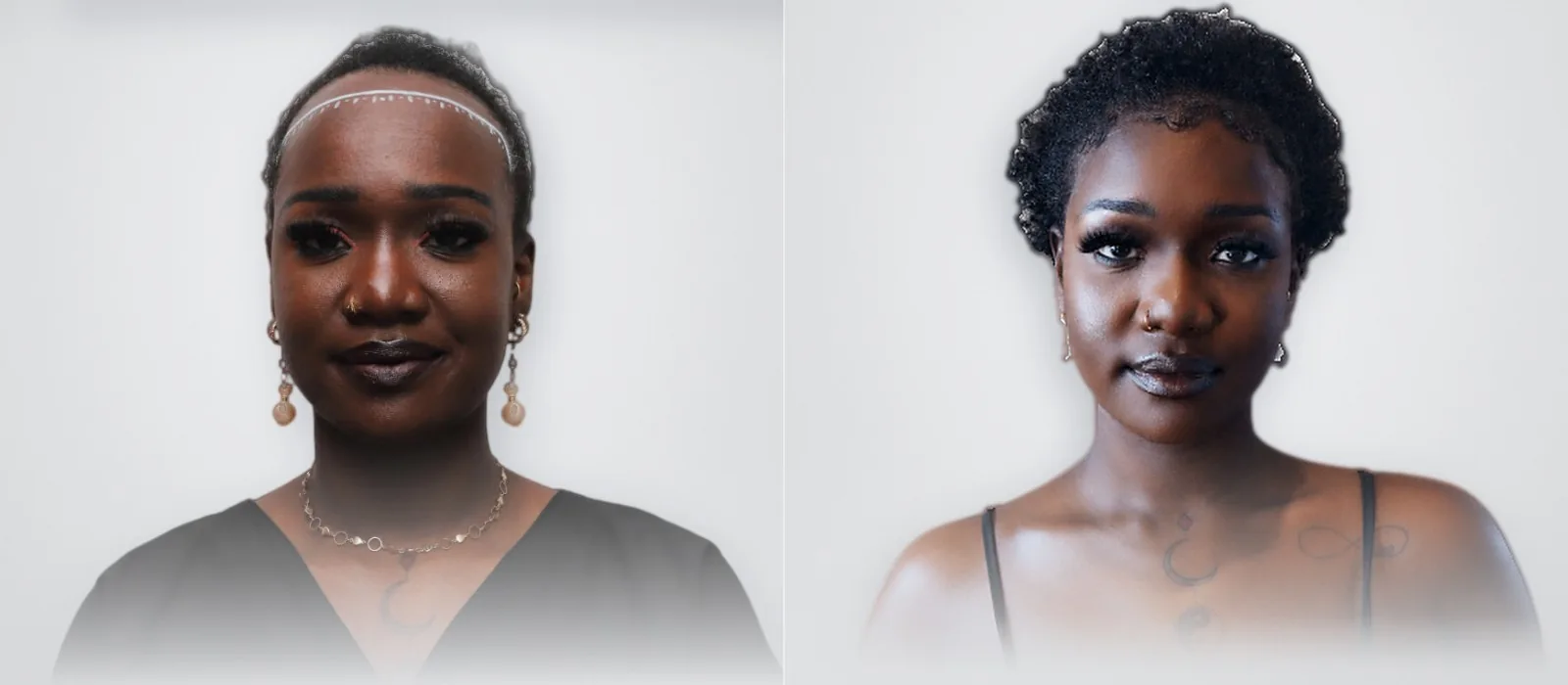 Janet Mai Sawyer before and after hair transplant