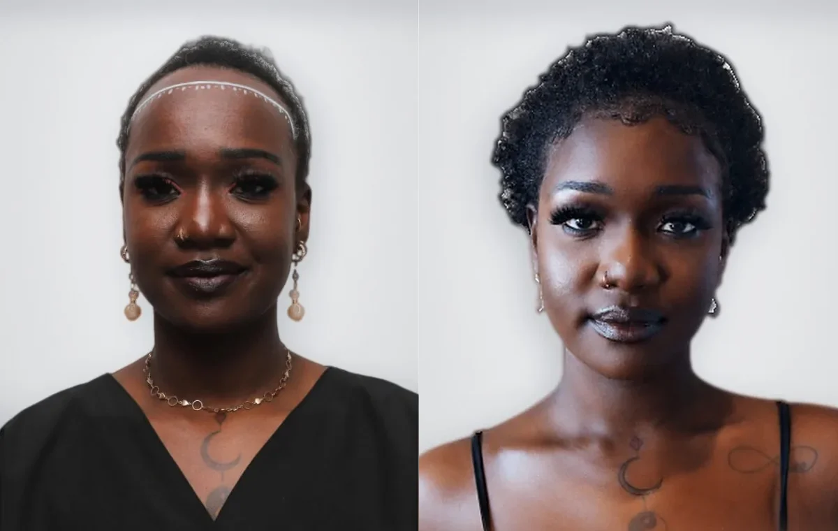 Janet Mai Sawyer قبل زراعة الشعر وبعدها