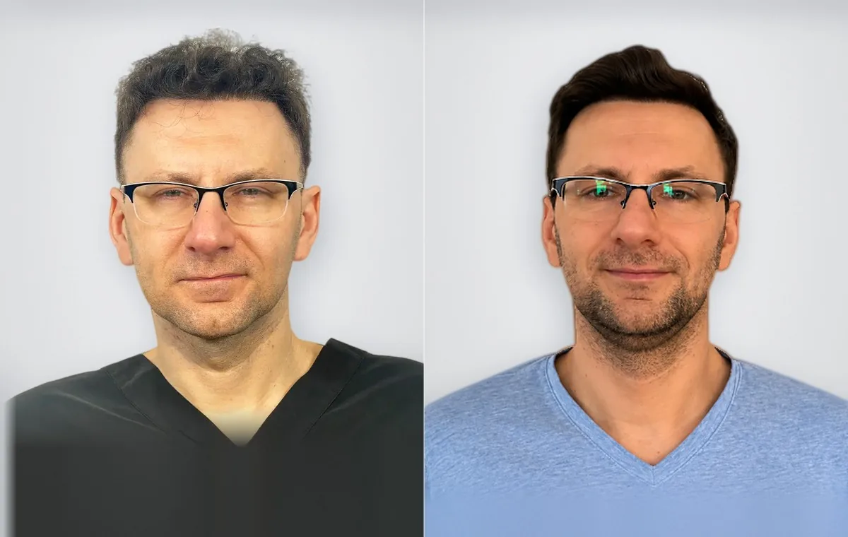 Jaroslaw Traczynska قبل زراعة الشعر وبعدها