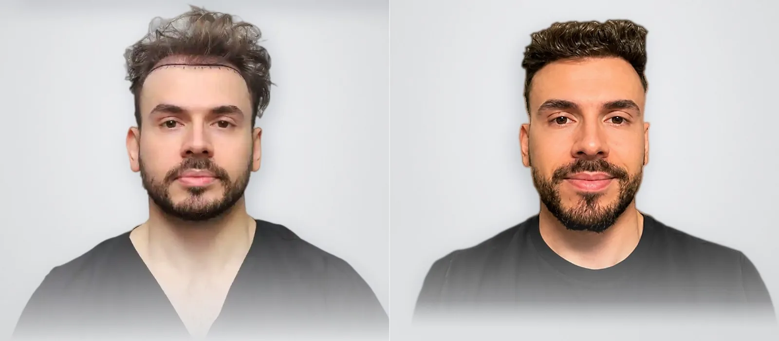Lucas Santana Soave قبل زراعة الشعر وبعدها