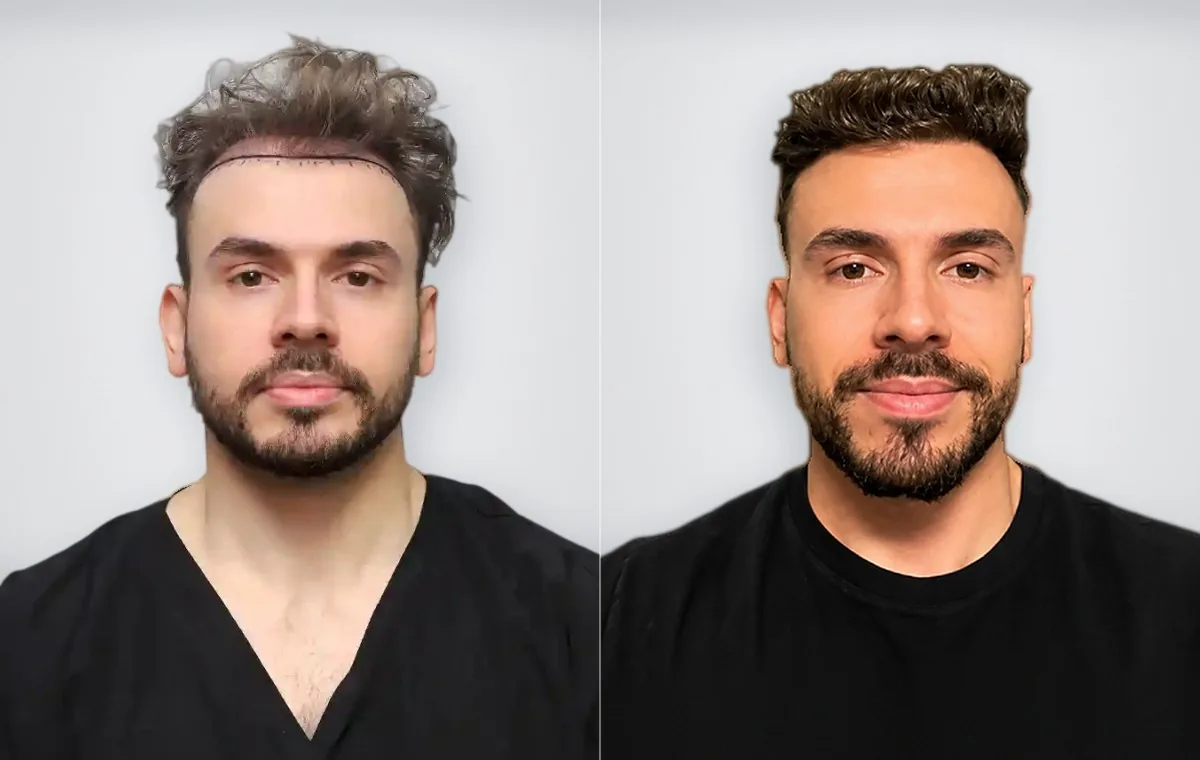 Lucas Santana Soave قبل زراعة الشعر وبعدها