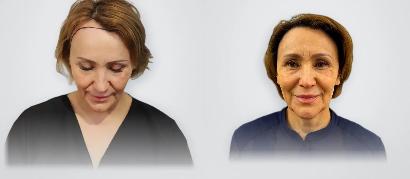 Roza Agibayeva before and after women's hair transplant