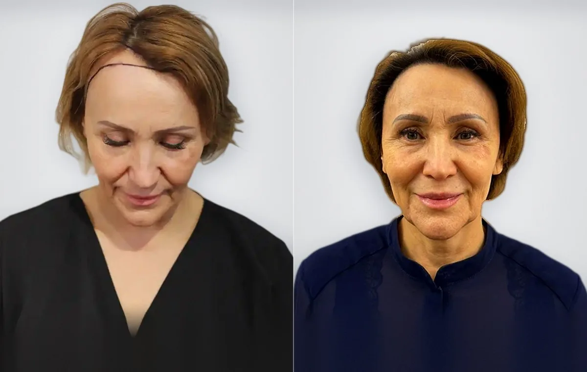 Roza Agibayeva قبل زراعة الشعر للنساء وبعدها