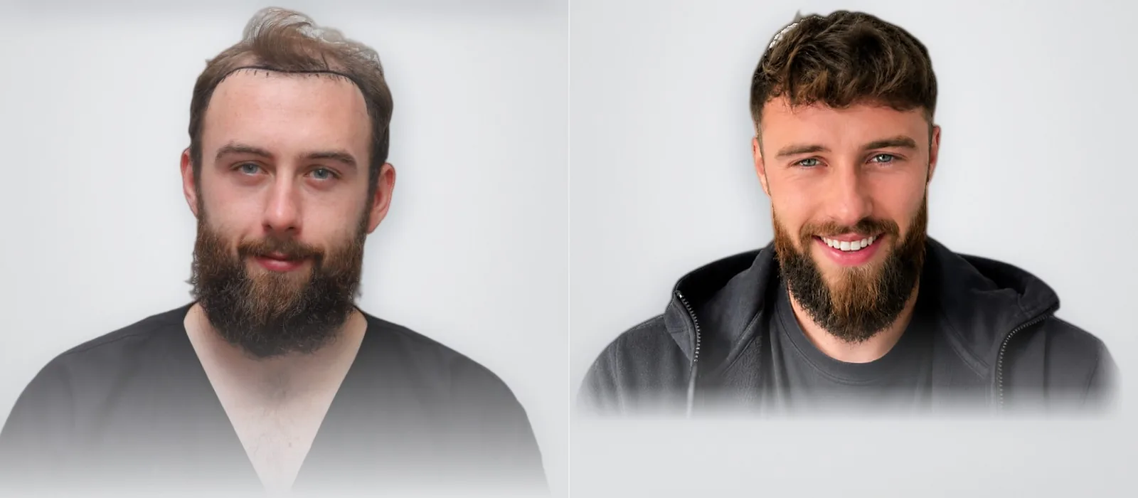 Sean Deverill قبل زراعة الشعر وبعدها