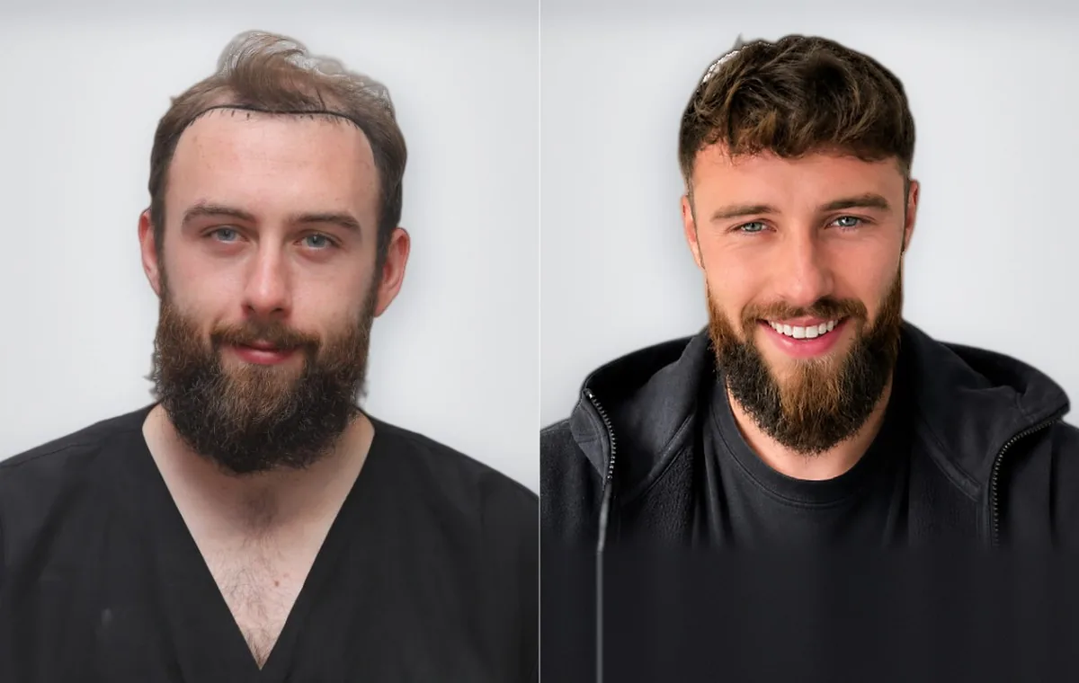 Sean Deverill قبل زراعة الشعر وبعدها