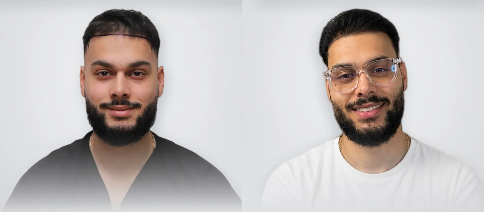 Sinan Sinay قبل زراعة الشعر وبعدها