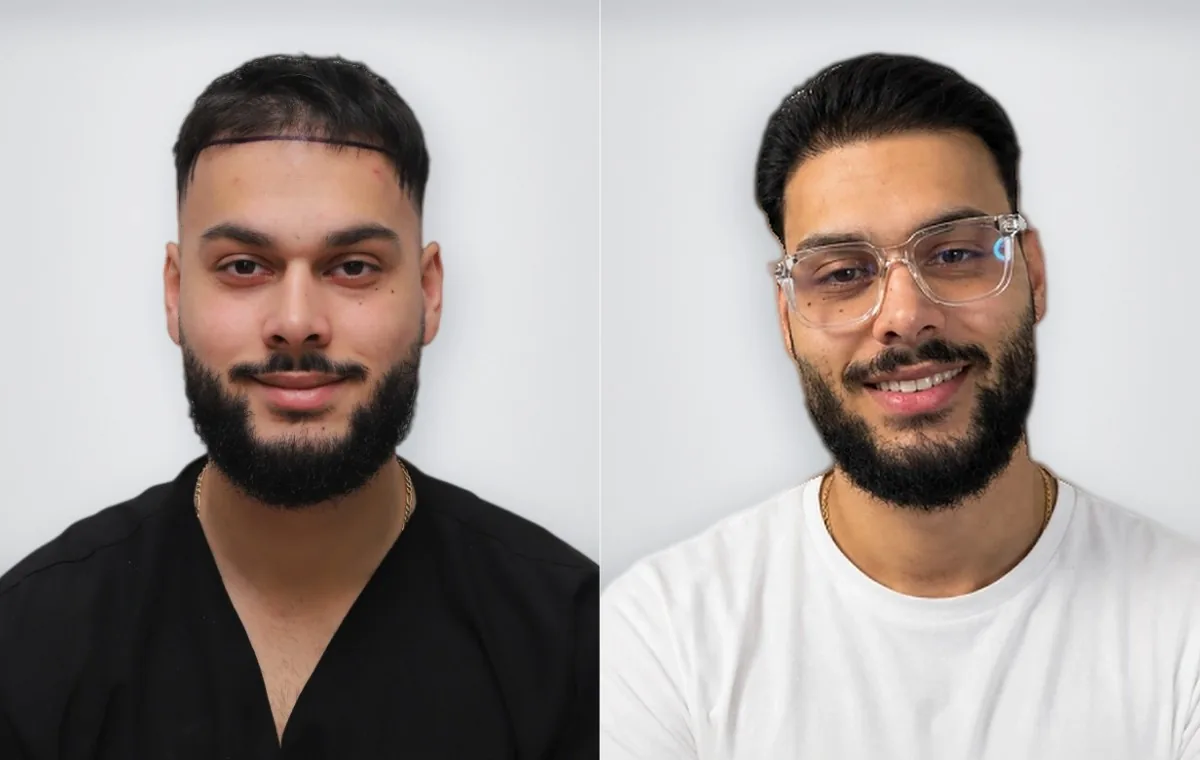 Sinan Sinay قبل زراعة الشعر وبعدها
