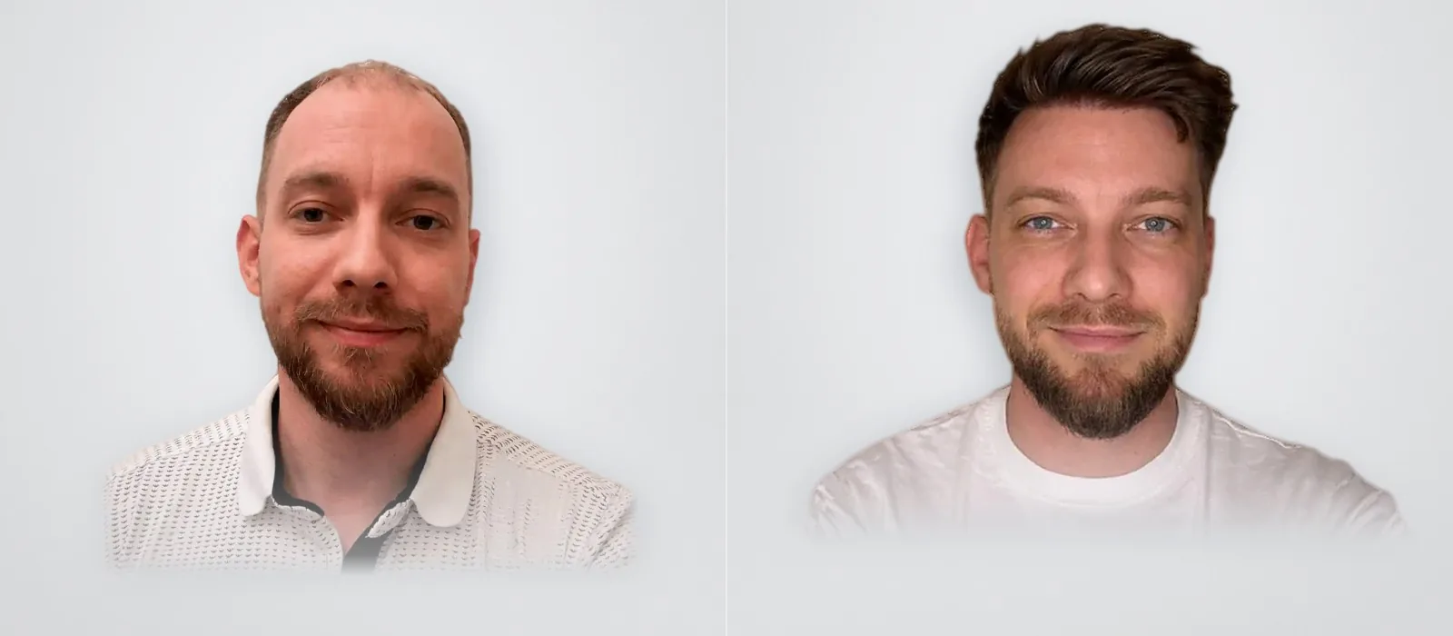 Tibor Jánoška before and after hair transplant