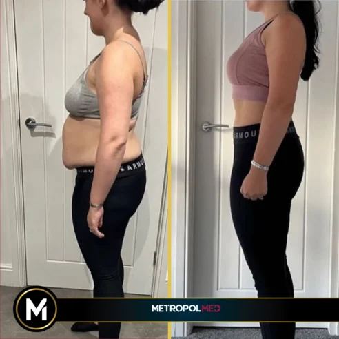 Abdominoplasty2