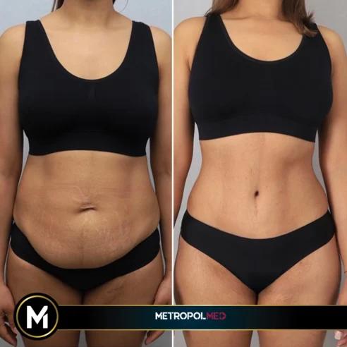 Abdominoplasty5