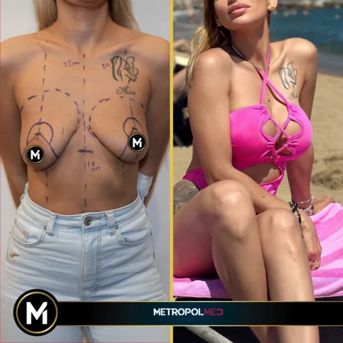 Breast-augmentation3