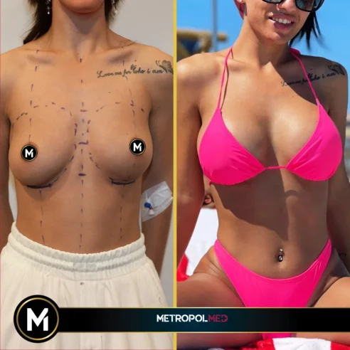 Breast-augmentation4