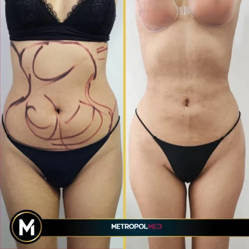 Liposuction