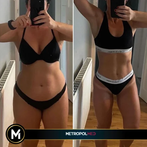 Liposuction2