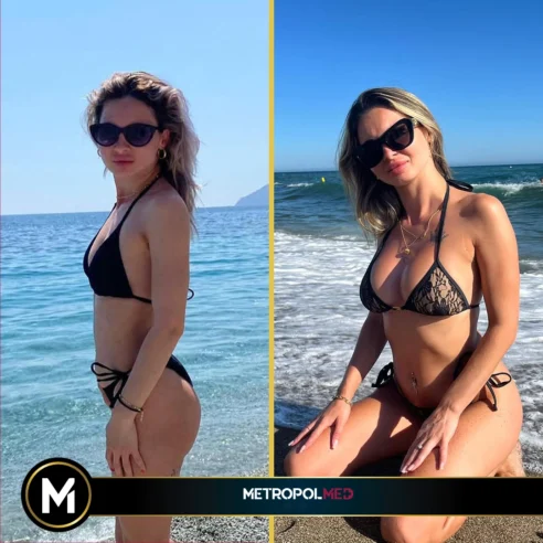 breast-augmentation2