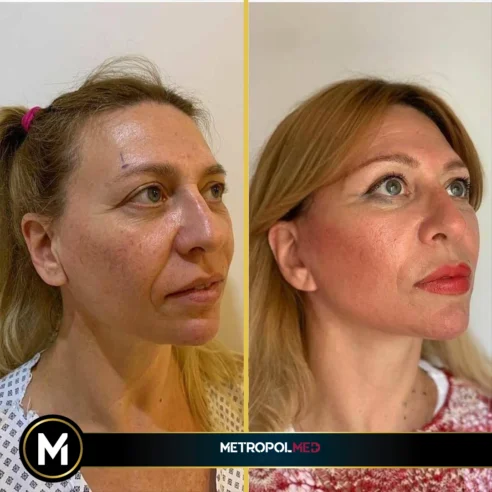 face-lift