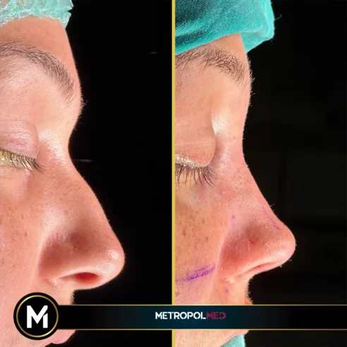 rhinoplasty2