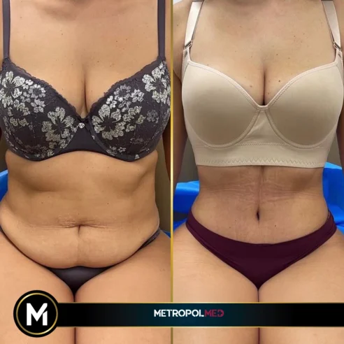 tummy-tuck-liposuction