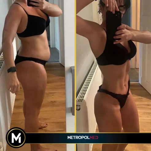 tummy-tuck-liposuction4