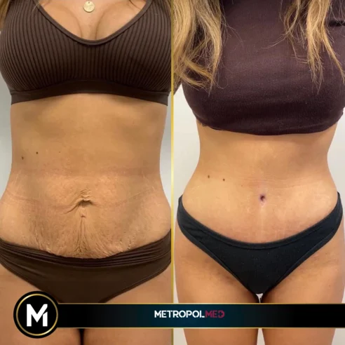 tummy-tuck1